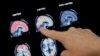 Drugs Fail to Slow Decline in Inherited Alzheimer's Disease